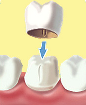 dental-crown
